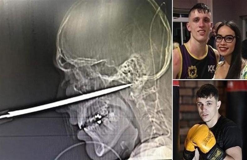 اخترق سكين جمجمته ونجا