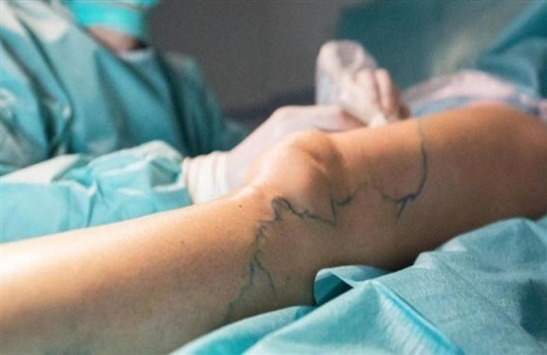  متى ينبغي استئصال دوالي الساقين؟