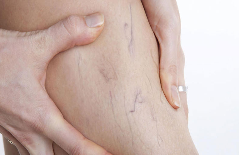 الأوردة العنكبوتية تهاجم المرأة بصفة خاصة