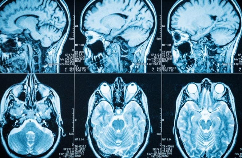 إصابة بـ مرض فتاك  يدمر دماغ البشر