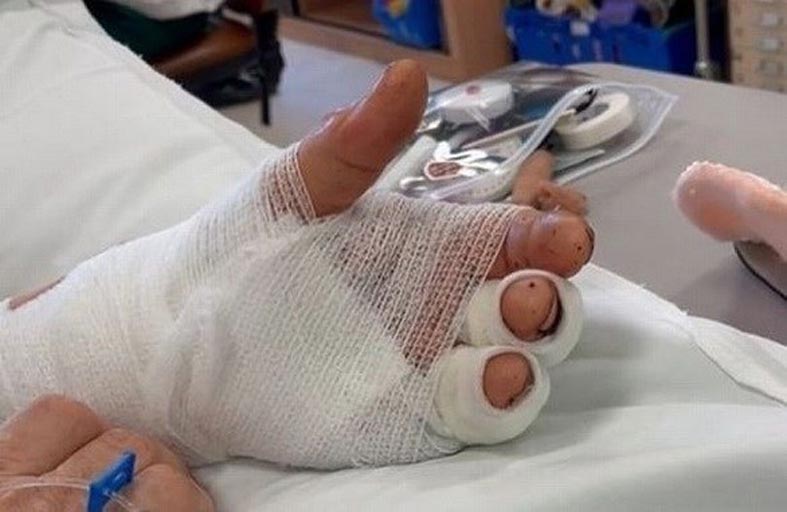 أطباء يعيدون وصل يد مريض في جراحة نادرة