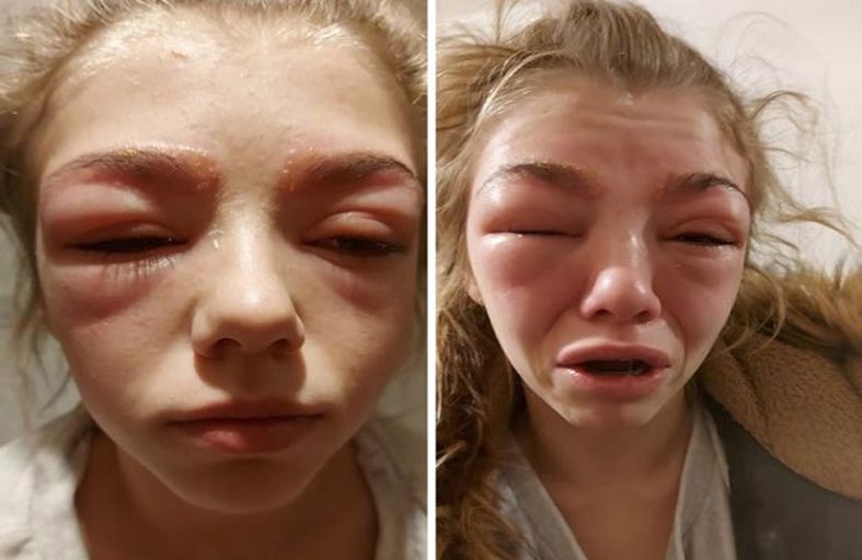 تكاد تفقد بصرها بسبب صبغ حاجبيها ورموشها