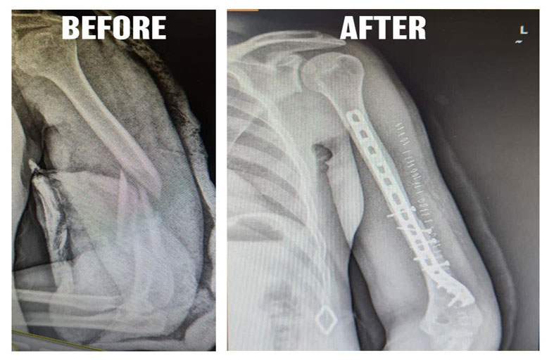 فريق بالسعودي الألماني ينجح في تثبيت كسر متفتت الأجزاء بعظمة العضد
