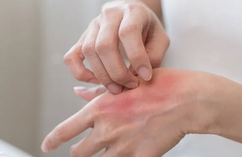 طبيبة تحدد نوع الحساسية غير القابل للعلاج