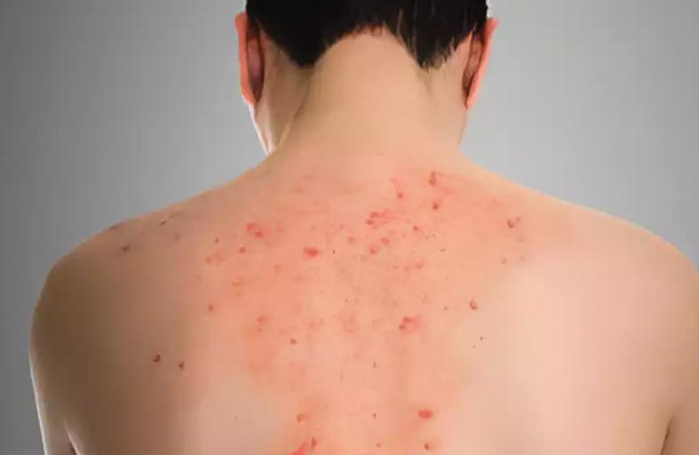 يُسبب أعراضاً خطيرة.. ماذا تعرف عن مرض فابري؟