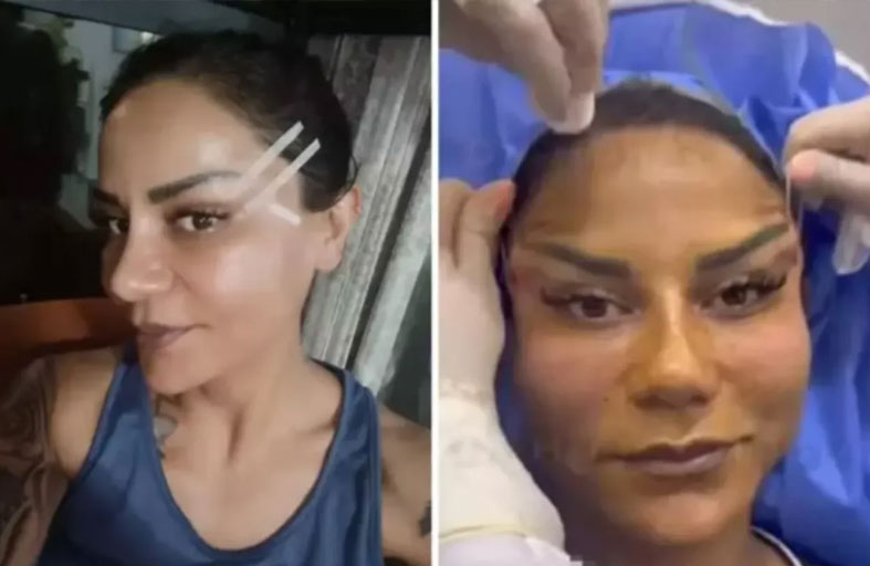 عملية تجميل فاشلة تحول حياة أربعينية إلى كابوس