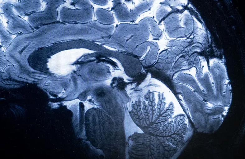 هذا ما يفعله فيروس كورونا بجذع الدماغ 