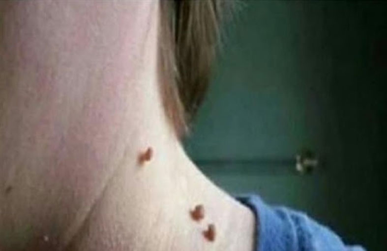 ما أسباب الثآليل لدى الأطفال؟