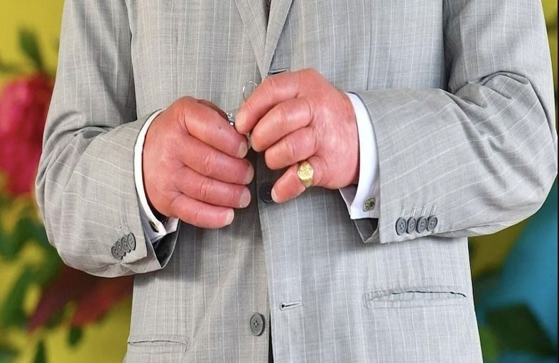 ماذا يكشف شكل أصابع الملك تشارلز عن حالته الصحية؟