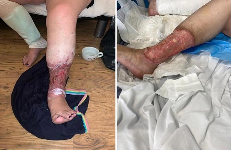 تكاد تفقد ساقيها بلدغة حشرة 