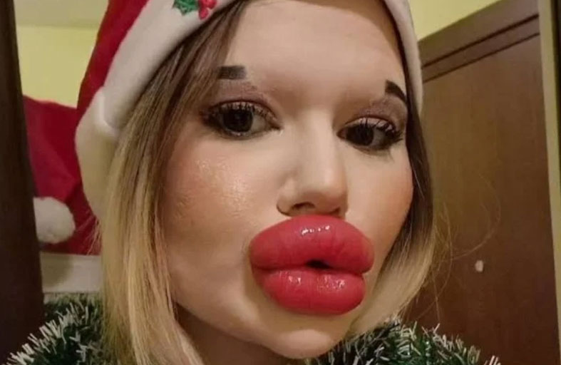 صاحبة أكبر شفاه في العالم ممنوعة من العلاج!