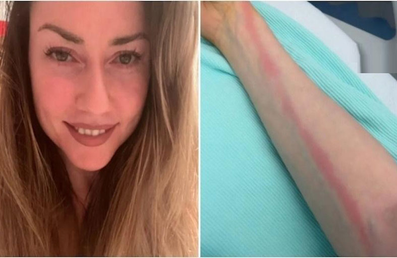 لعبة بولينغ تتسبب بتعفن الدم لامرأة 