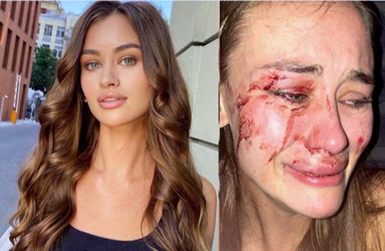 عارضة أزياء تتعرض لاعتداء مروع 