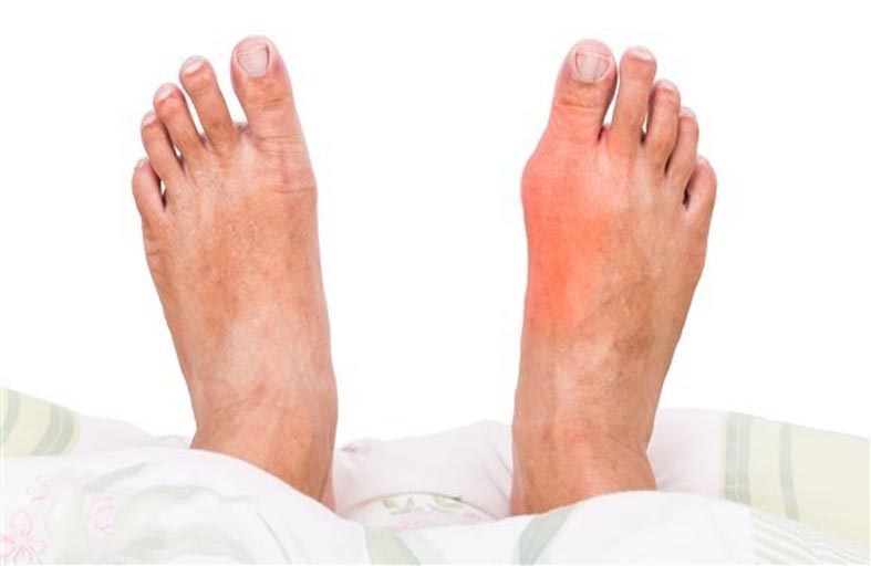 هؤلاء هم الأكثر عرضة للإصابة بالنقرس