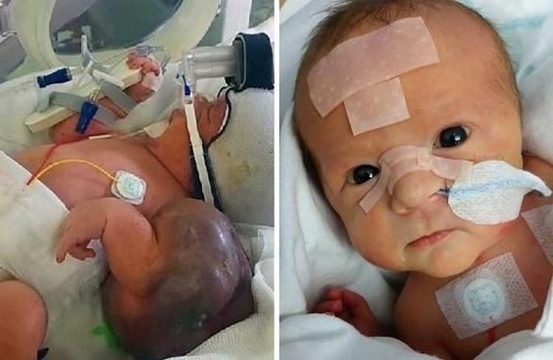 طفل يولد بورم في ذراعه أكبر من رأسه