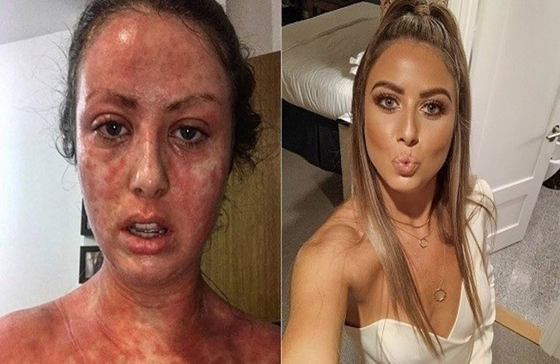 تشفى من الأكزيما بكريم مصنوع من البُن