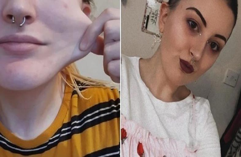 تعاني من حالة تتسبب في تشقق جلدها وتكسر عظامها