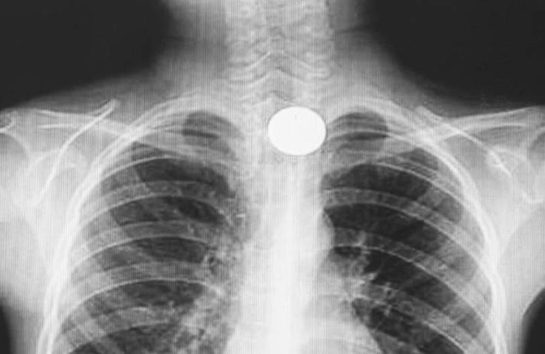 تحذير عاجل من خطر البطاريات على الأطفال