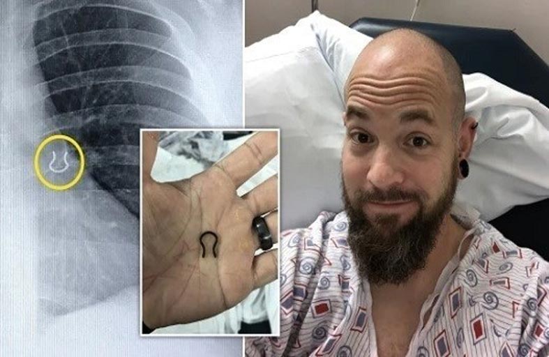 يعثر على حلقة أنف فقدها من 5 سنوات في رئته