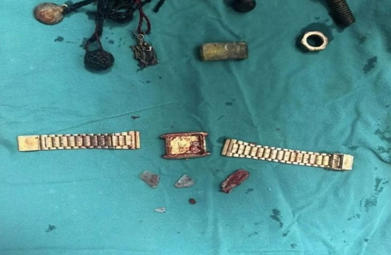 ساعة عالقة في المريء ومسامير في الأمعاء! 