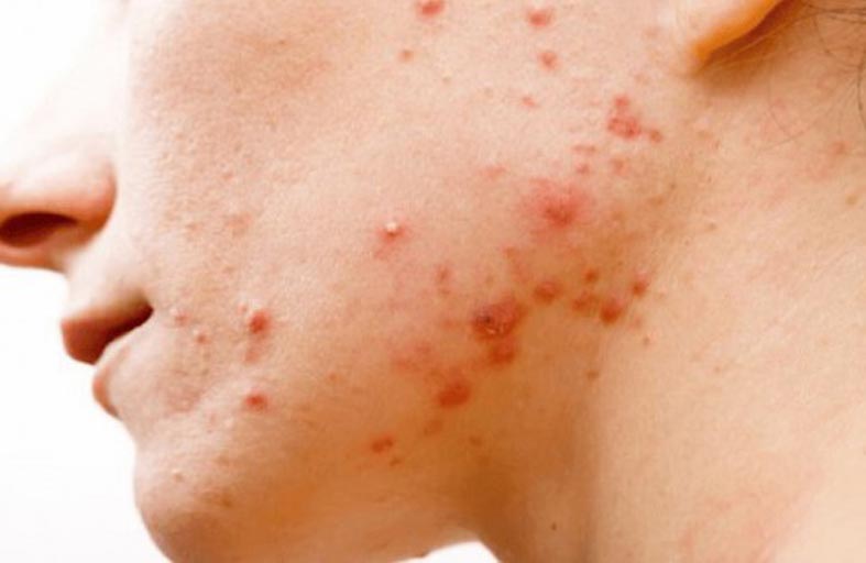 علاج جديد لحَب الشباب ينتشر ببطء