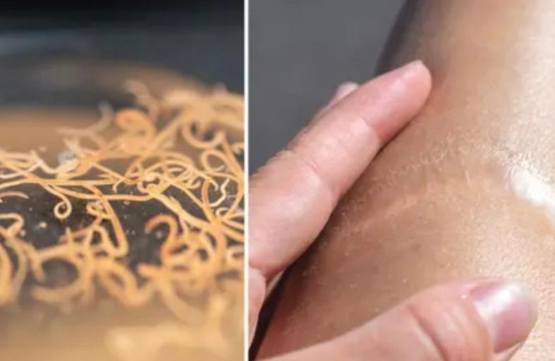 دودة تعمل على علاج ندوب البشر