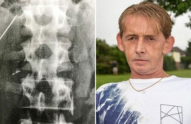 إبرة مغروسة في كبده 15 عاماً دون أن يدري