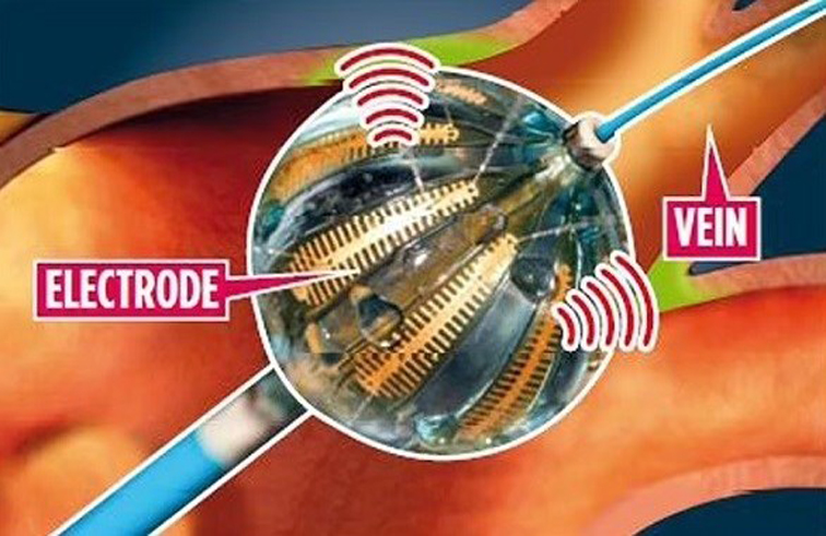 بالون بحجم حبة العنب ينظم ضربات القلب