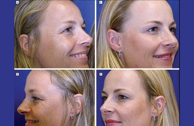 توأم إحداهما خضعت للبوتوكس على عكس أختها