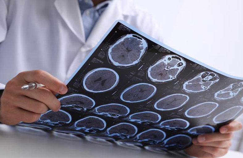 عقار متاح لسرطان الثدي قد يبطئ نمو ورم دماغي عدواني يصيب الأطفال