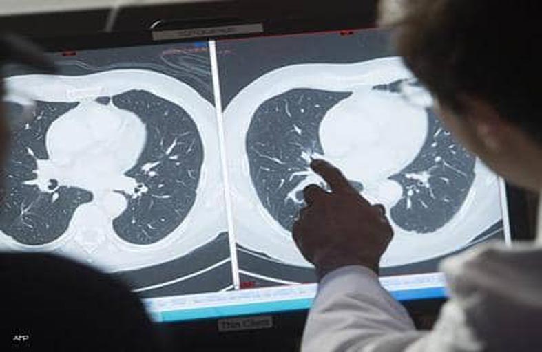 جرس إنذار لمرض خطير.. لا تهمله