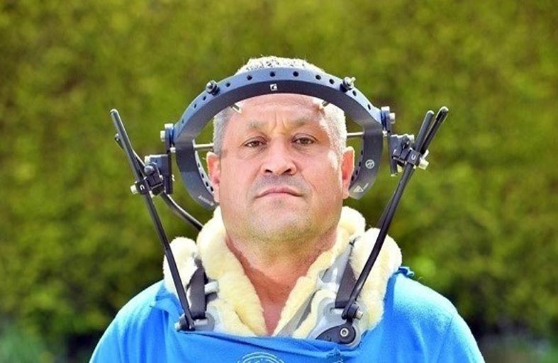 يعيش مع حلقة معدنية بجمجمته بسبب حادث