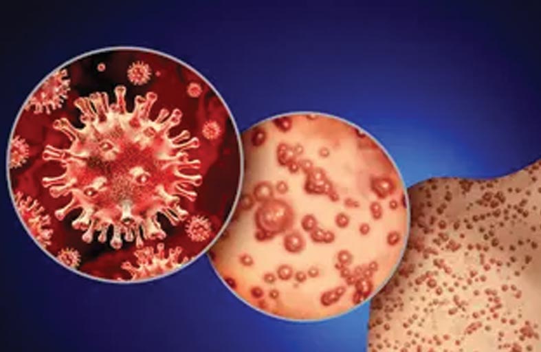 «جدري القردة».. انتشار فيروسي يستنفر الصحة العالمية