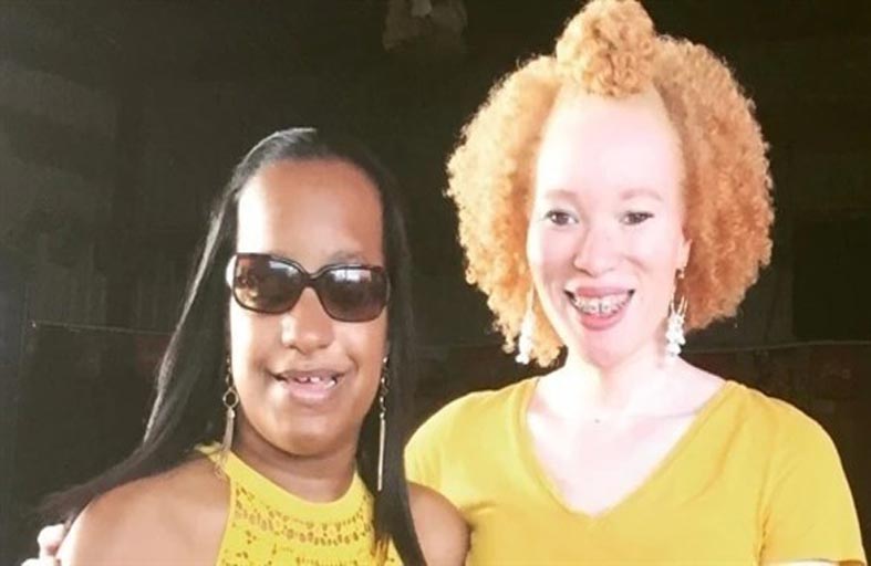 تتحدى حالة نادرة تسببت بـ 100 كسر في جسمها