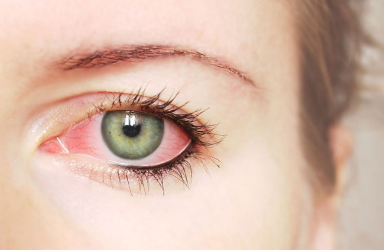 التهاب الملتحمة.. أعراض تستدعي زيارة الطبيب