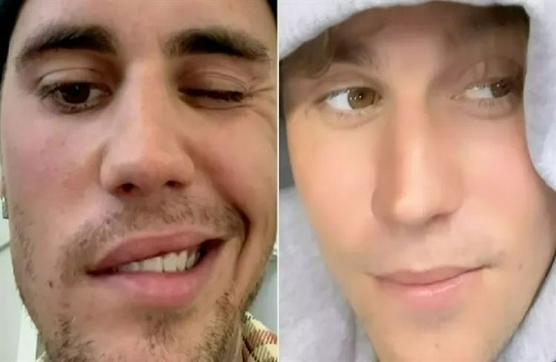 جاستن بيبر يكشف إصابته بمرض خطير 