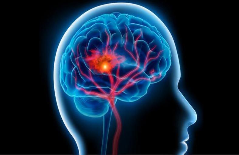 سبع عادات بسيطة تقلل من خطر الإصابة بالجلطة الدماغية