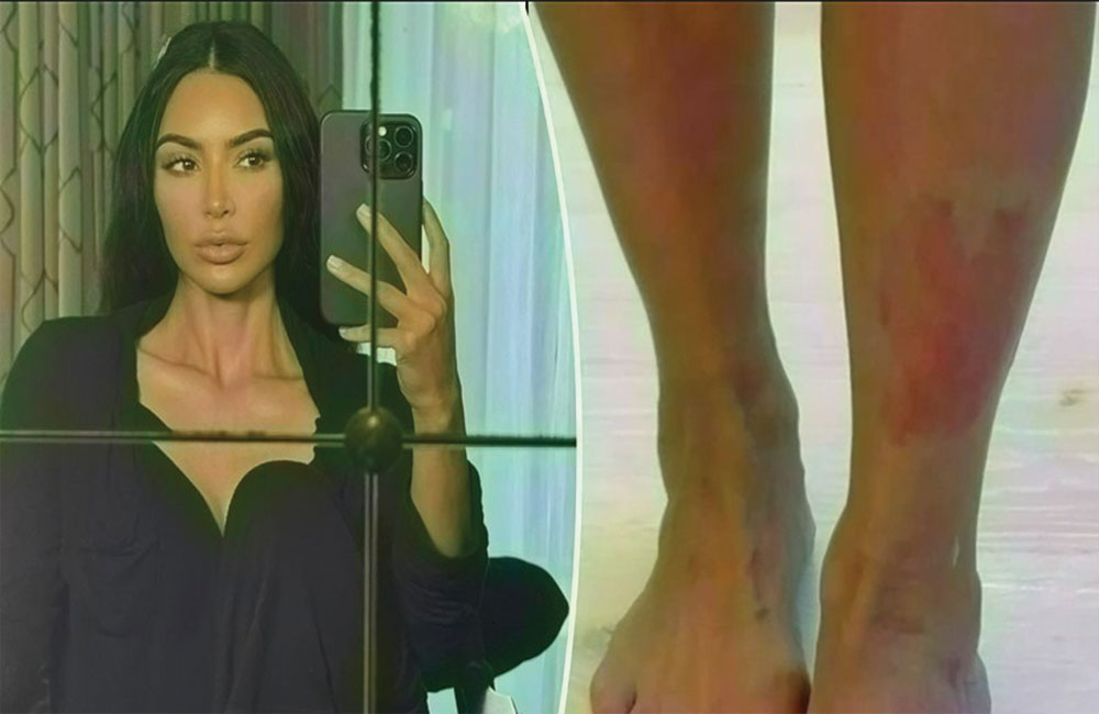 كيم كارداشيان تكشف تفاقم معاناتها مع الصدفية