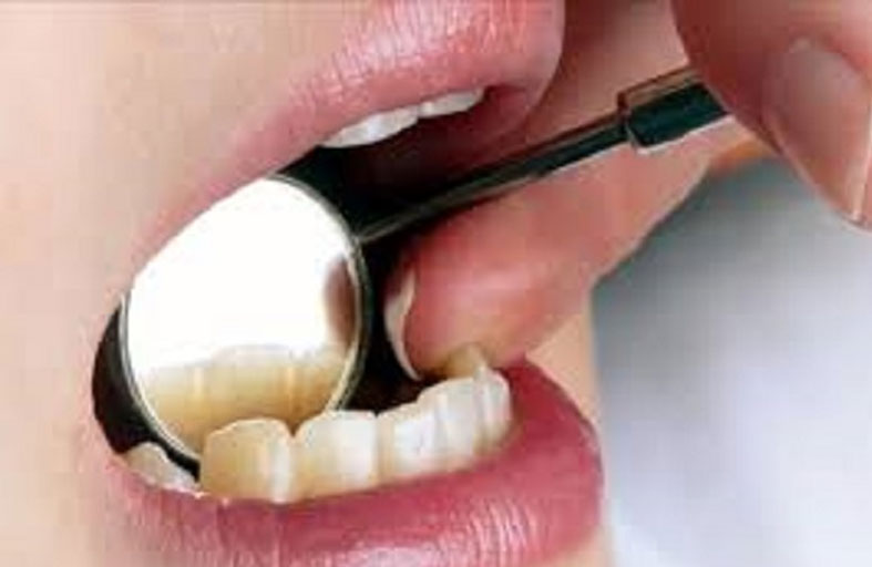 تأثير تسوس الأسنان على صحة القلب والمفاصل