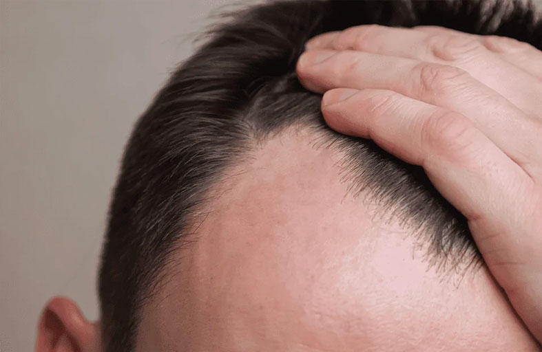 الصلع الوراثي عند الرجال قد يؤثر على القدرة الإنجابية