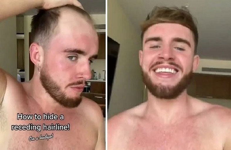 يكشف عن حيلة ذكية لإخفاء إصابته بالصلع 