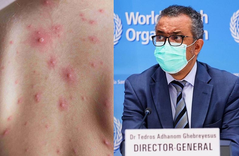 تصريح مطمئن من الصحة العالمية بشأن جدري القردة