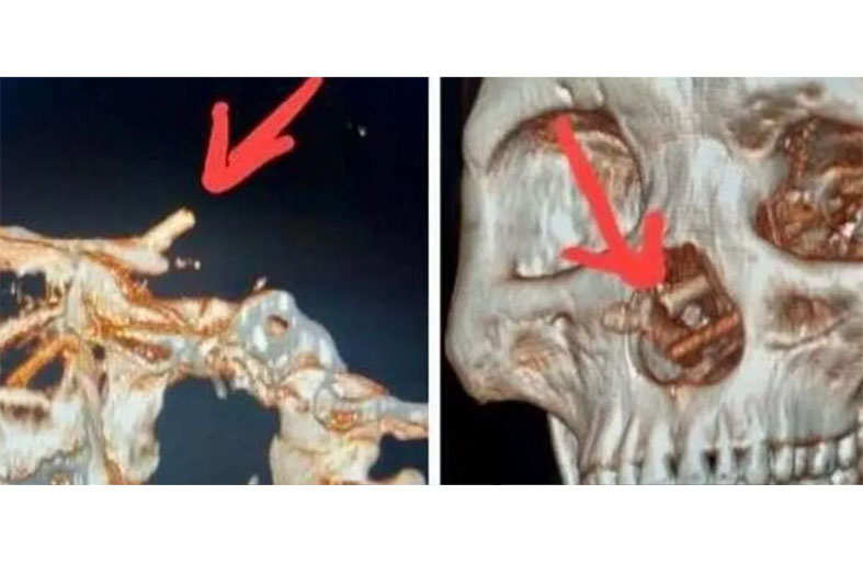 رجل يكتشف مفاجأة داخل جمجمته