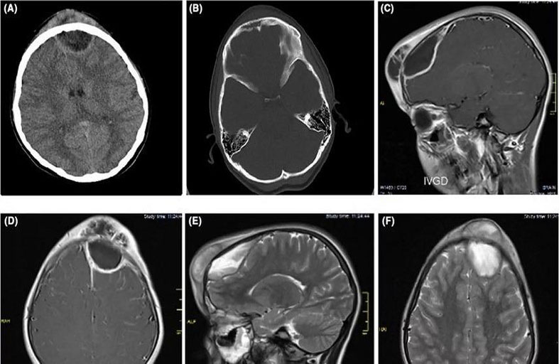 بثرة على جبين فتاة تتحول إلى ورم مميت
