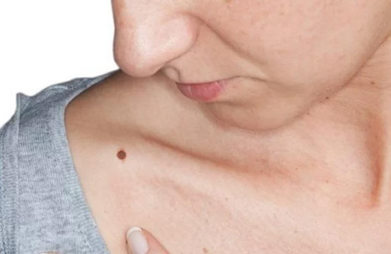 هل إصابة الشامة تؤدي إلى السرطان؟