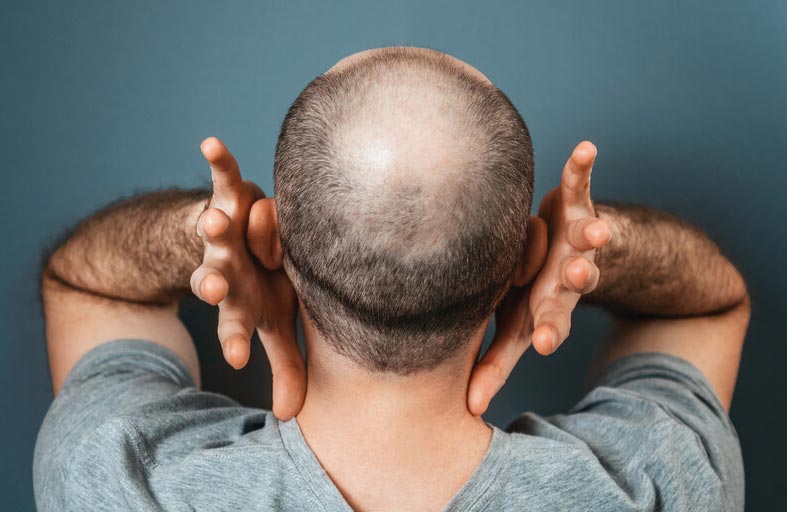 اكتشاف سكر لعلاج الصلع الوراثي عند الرجال