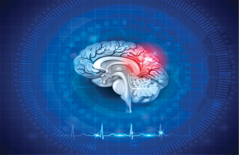 اكتشاف علامة تشير إلى خطر حدوث نزيف دماغي