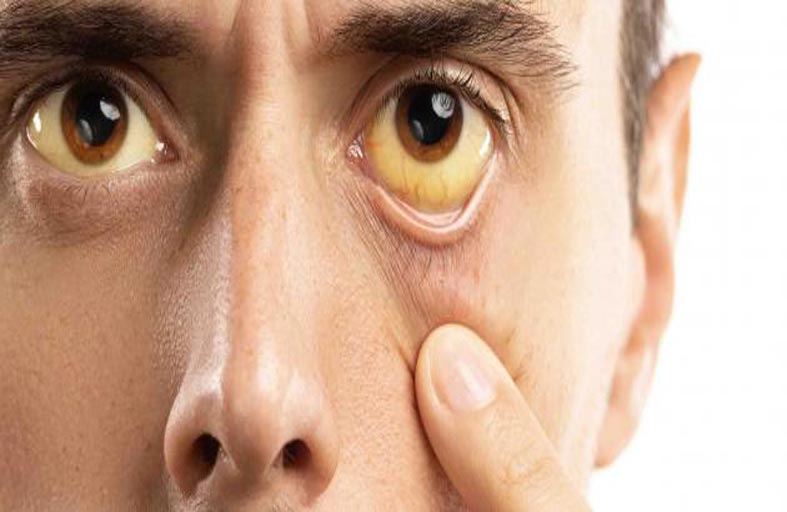 ما أسباب اصفرار العين؟