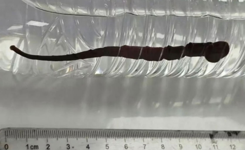 كائن حي يخرج من فم طفل يعاني من السعال