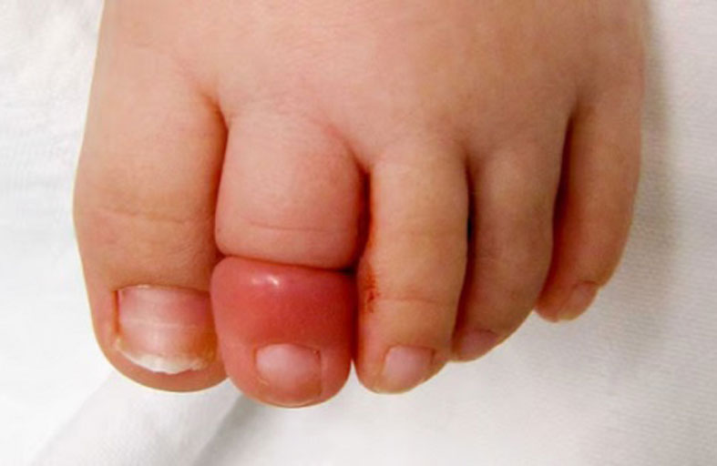 رضيعة كادت تفقد إصبعها بسبب شعر والدتها